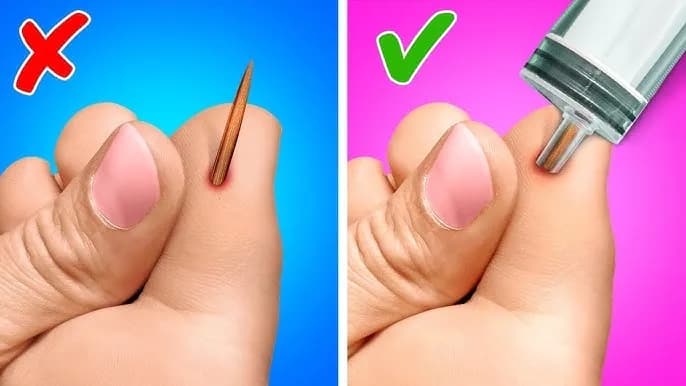 Jak lekarz wyjmuje drzazgę spod paznokcia - poznaj bezpieczną metodę usunięcia