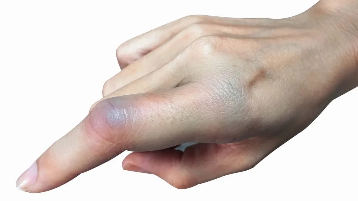 Wybity palec do jakiego lekarza? Sprawdź, jak uniknąć bólu i komplikacji