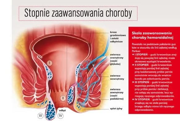 Do jakiego lekarza z hemoroidami? Ważne informacje, które musisz znać