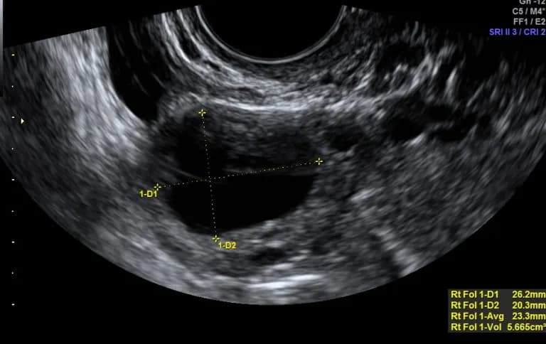 USG po owulacji co widać: kluczowe zmiany w jajnikach i macicy