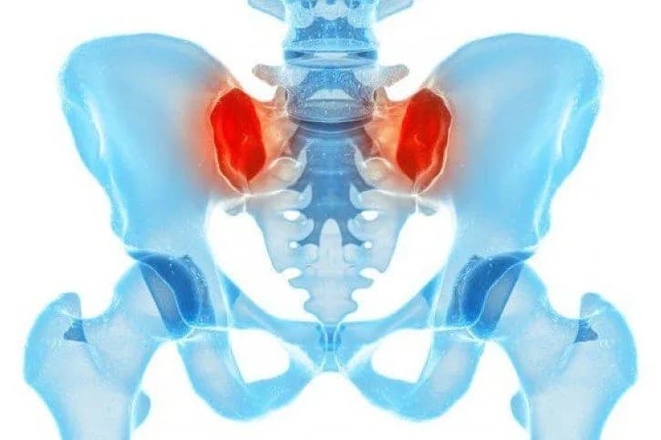Jakie leczenie i lekarz przy zapaleniu stawu krzyżowo-biodrowego?